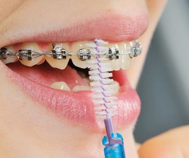 tụt lợi khi niềng răng