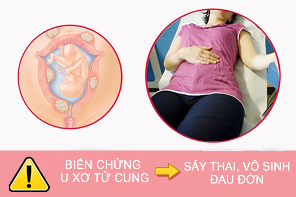 dấu hiệu u xơ tử cung