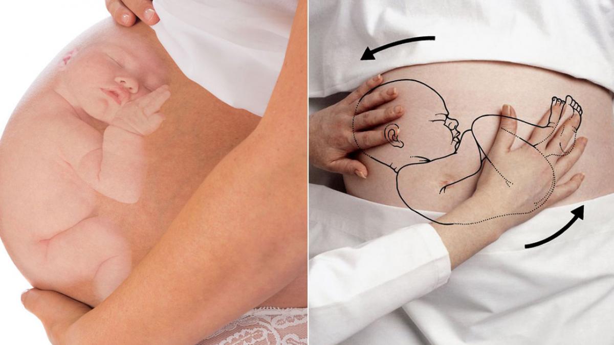 u xơ tử cung khi mang thai