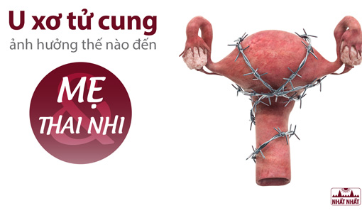 u xơ tử cung khi mang thai