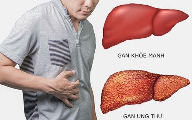 Ung thư gan có nhiều dấu hiệu nhận biết