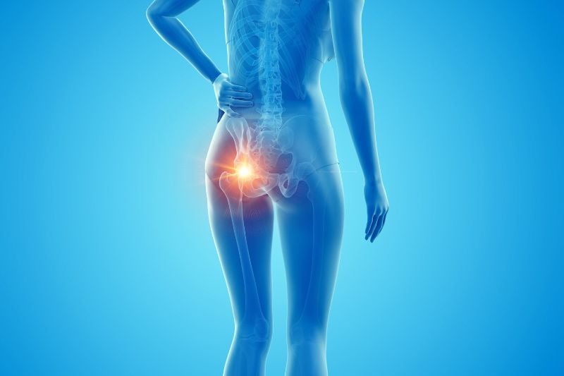 Vận động mạnh có thể gây thoái hóa khớp háng