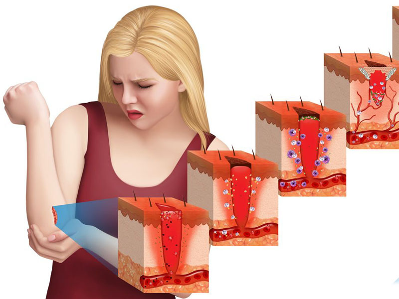 vết bỏng bị ngứa