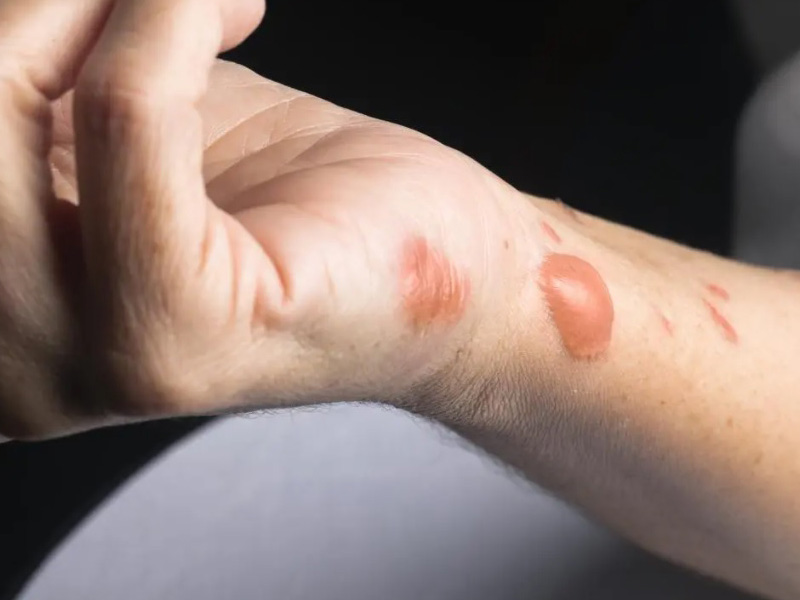 vết bỏng bị ngứa