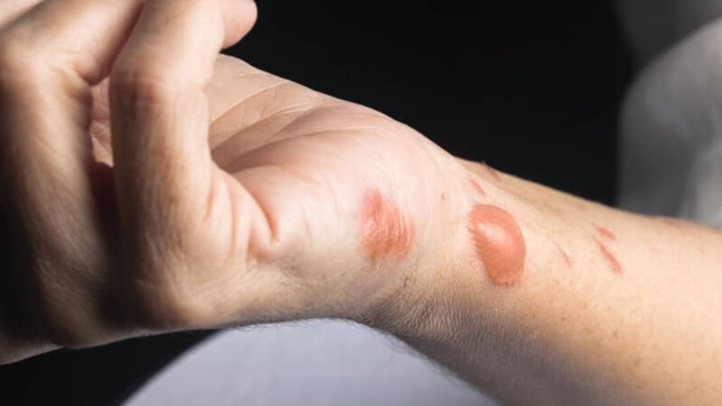 Vết bỏng độ 2 thường xuất hiện phồng nước