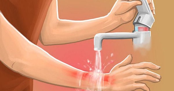 cách giúp vết bỏng mau lành