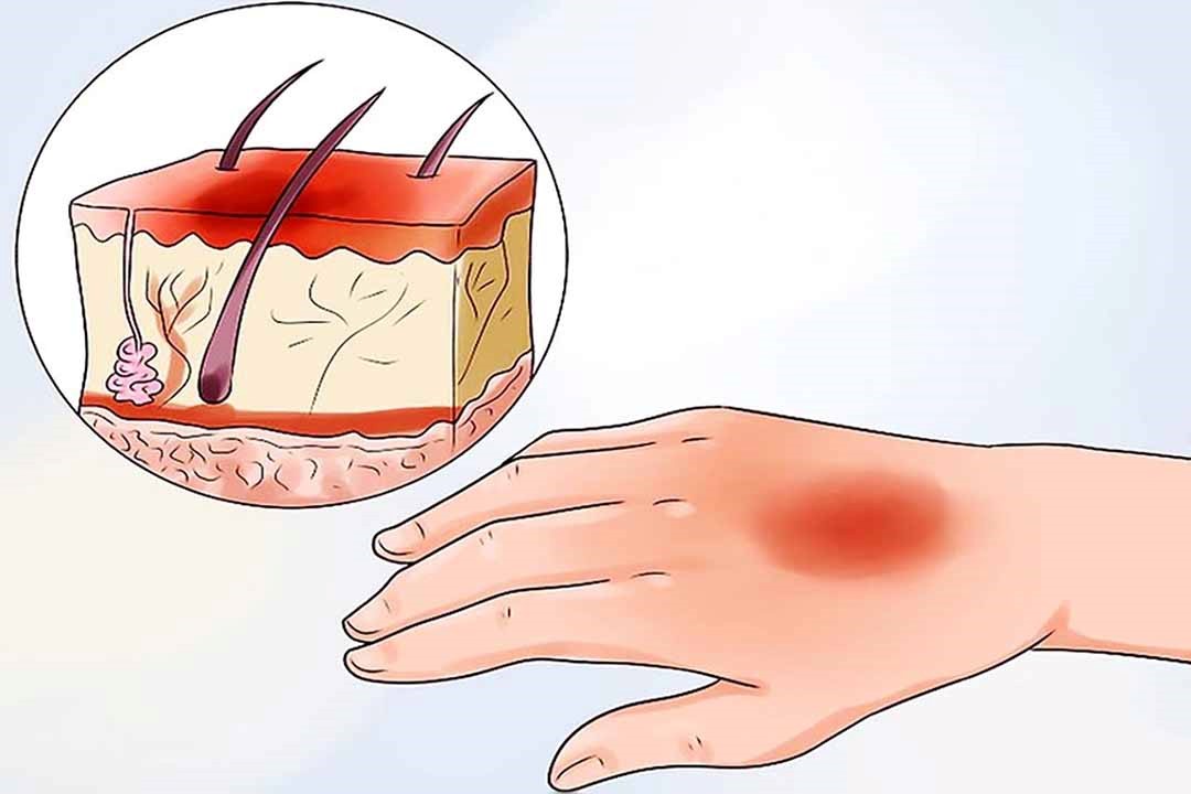 cách giúp vết bỏng mau lành