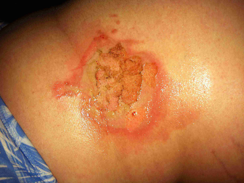 dấu hiệu vết bỏng bị nhiễm trùng