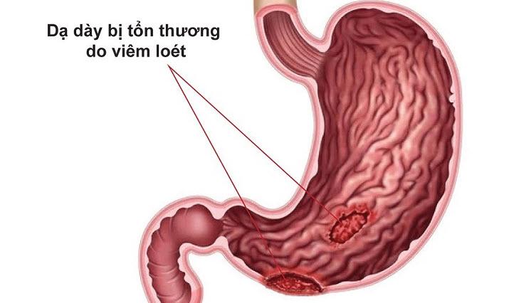 Vết loét hình thành khi bất kỳ sự kết hợp nào của axit dạ dày dư thừa, vi khuẩn…