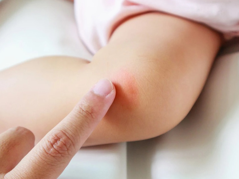 kem bôi muỗi đốt