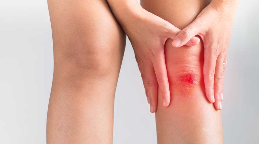 Vết thương hở rất phổ biến trong cuộc sống hàng ngày