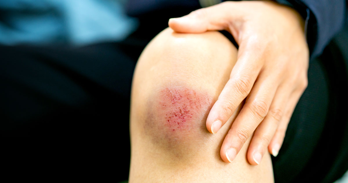 Vết thương hở thường xuyên gặp phải trong cuộc sống hàng ngày