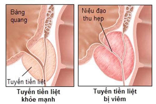 Bệnh viêm tuyến tiền liệt cần được điều trị sớm