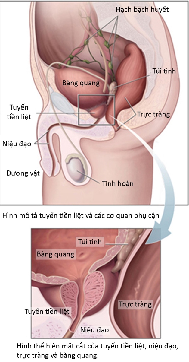 hình ảnh bệnh viêm tuyến tiền liệt