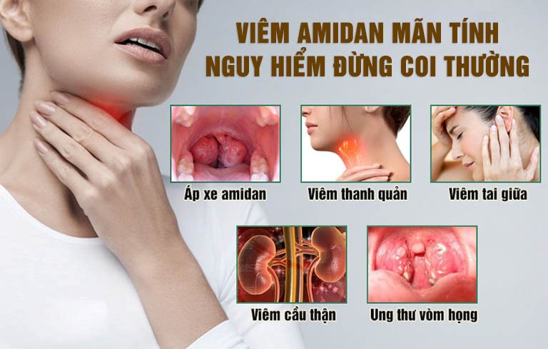 viêm amidan có mủ