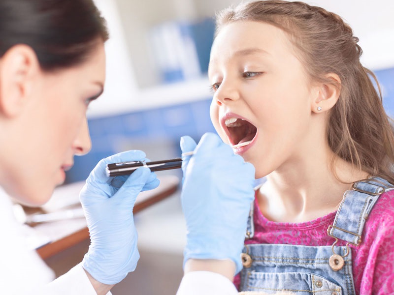 Viêm họng amidan mạn tính