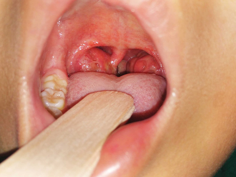 Viêm họng amidan mạn tính