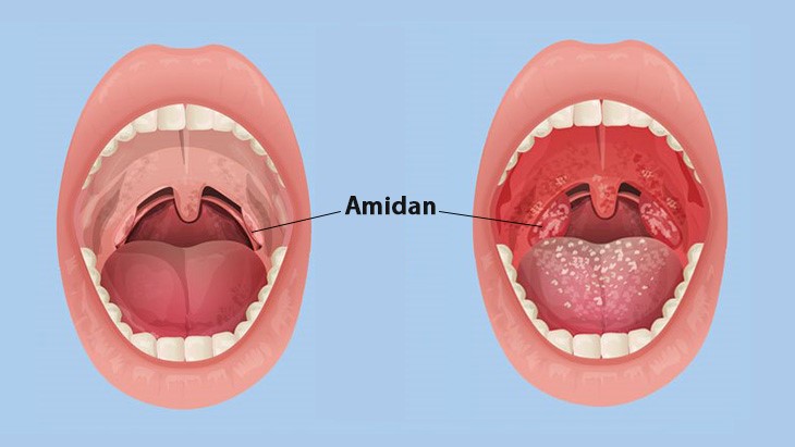 viêm amidan ở trẻ 2 tuổi