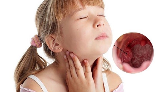 viêm amidan quá phát ở trẻ em