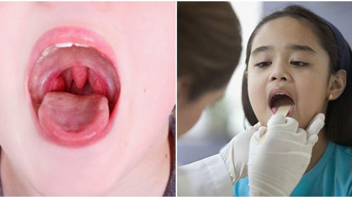 Viêm amidan quá phát 