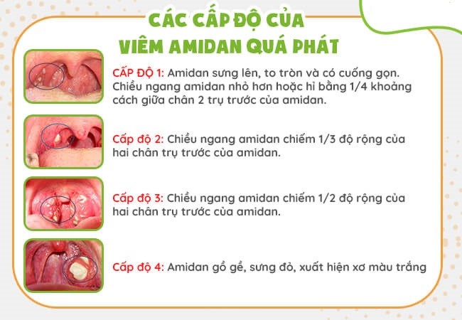 Viêm amidan quá phát 