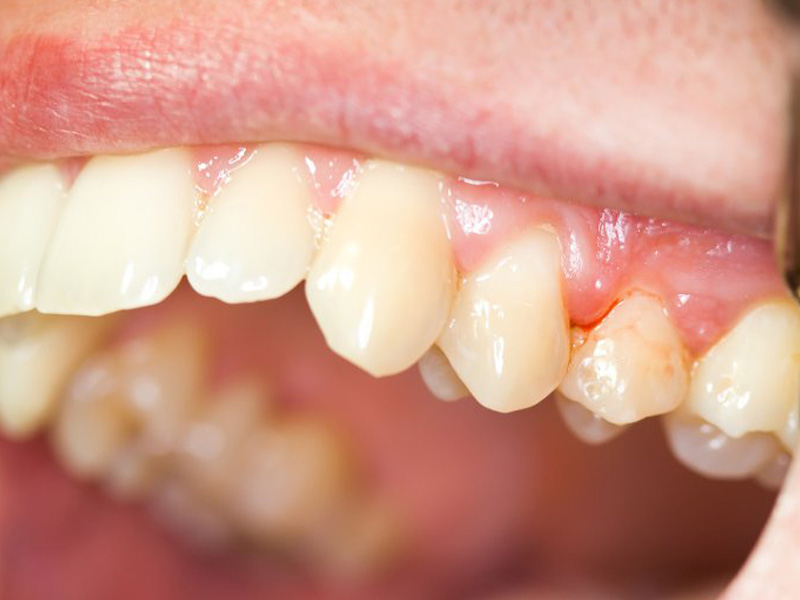 bị viêm chân răng