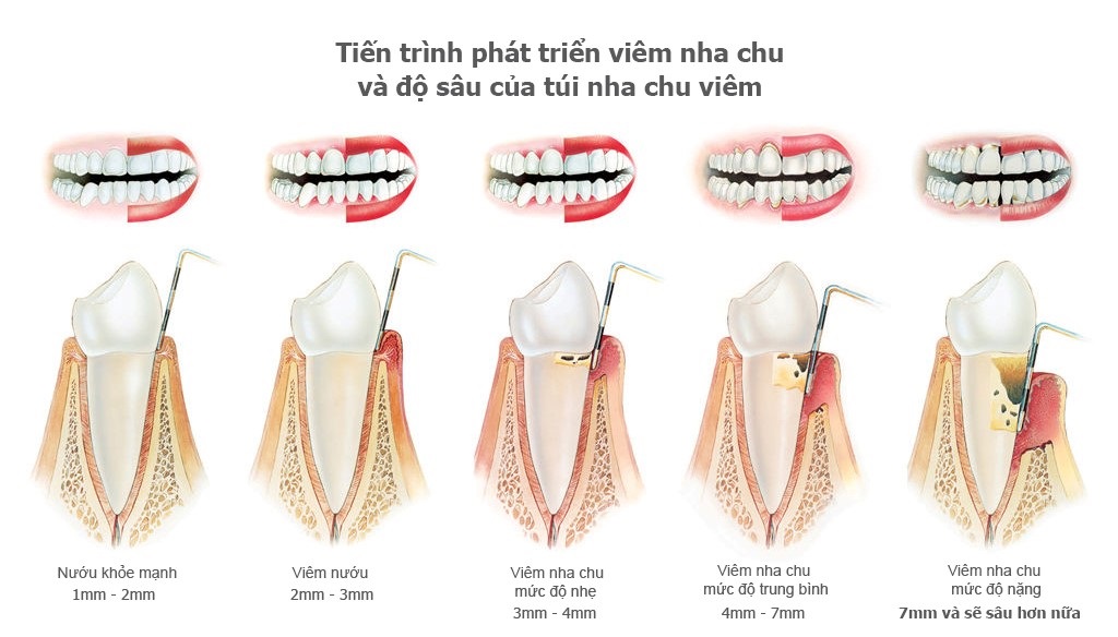 viêm chân răng có mủ uống thuốc gì