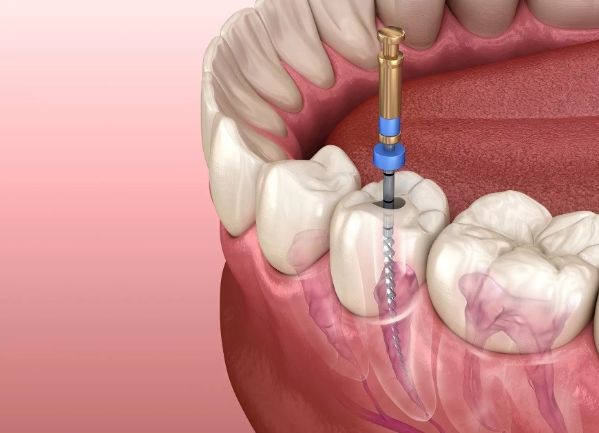 Viêm chân răng hàm có mủ 