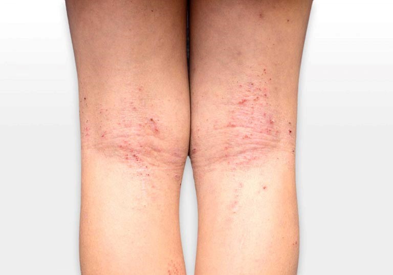 cách giảm ngứa khi bị viêm da cơ địa