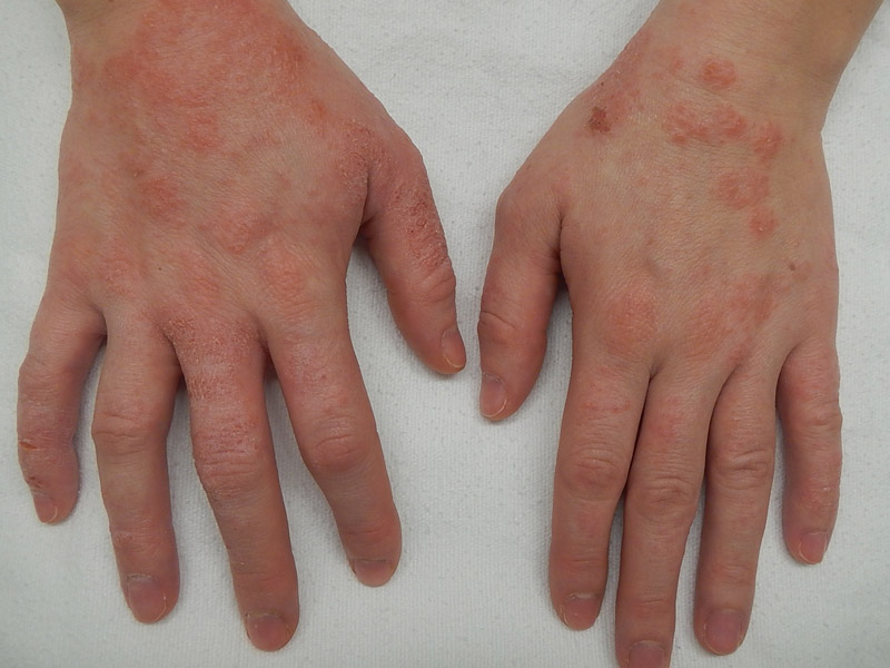 Vẩy nến và viêm da cơ địa 