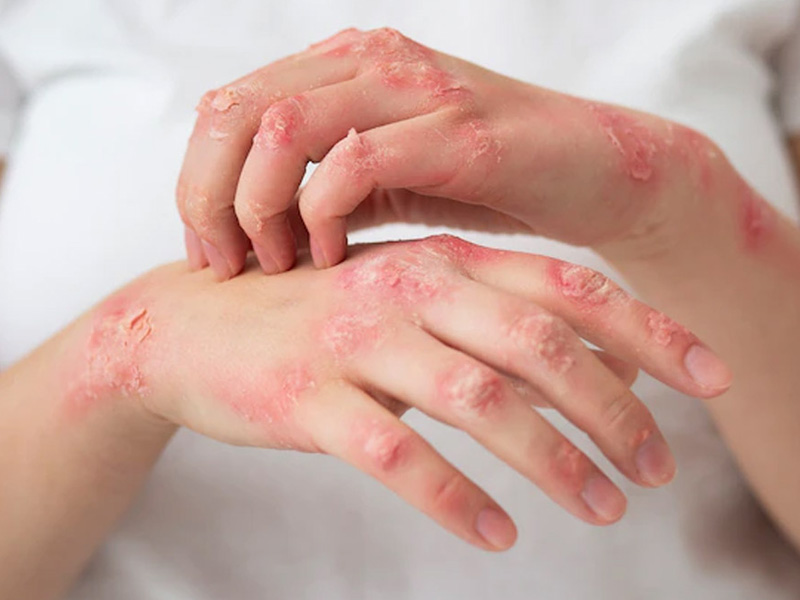 Vẩy nến và viêm da cơ địa 