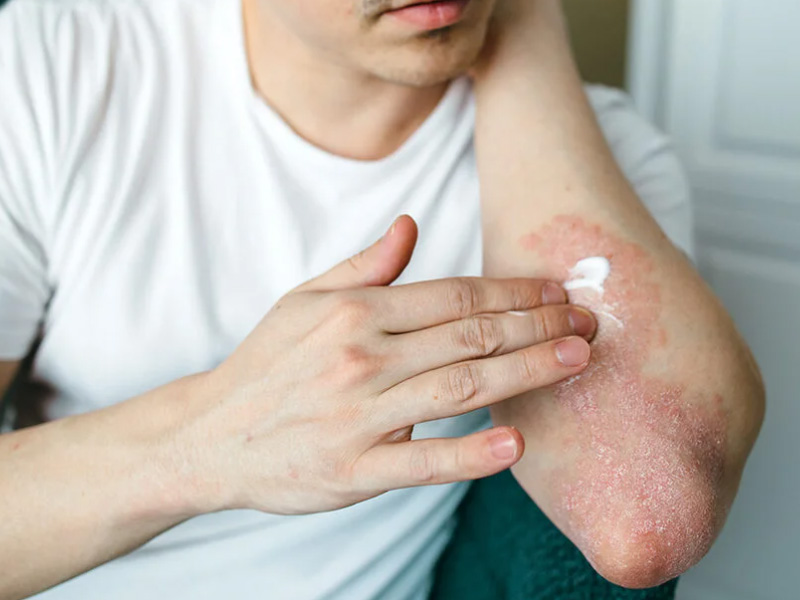 Vẩy nến và viêm da cơ địa 