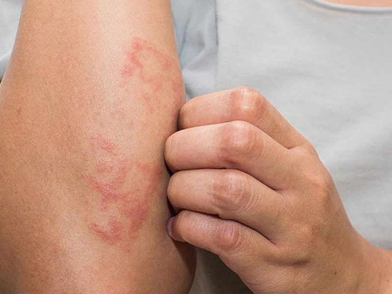 Vẩy nến và viêm da cơ địa 