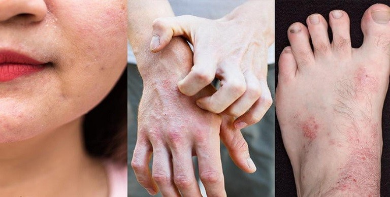 cách giảm ngứa khi bị viêm da cơ địa