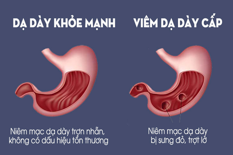 Viêm dạ dày có thể dẫn đến xuất huyết dạ dày