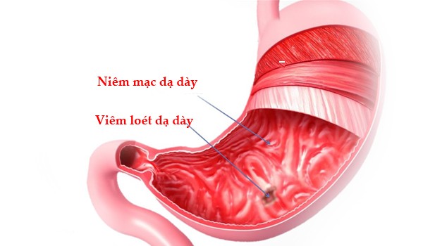 Viêm dạ dày mãn tính có nguy hiểm không