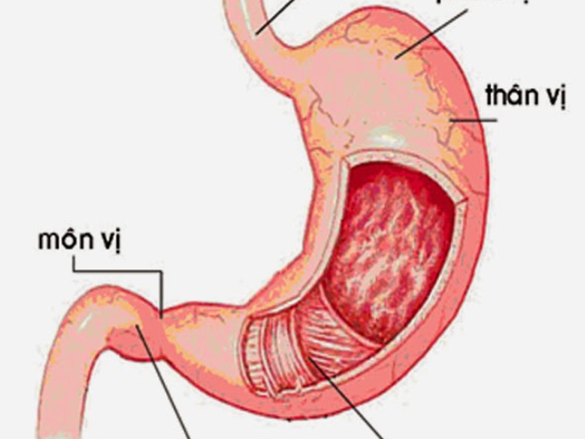 Viêm dạ dày mãn tính có nguy hiểm không