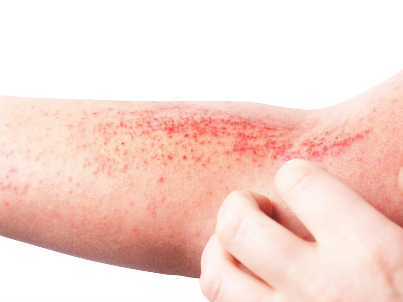 Bệnh viêm da tiếp xúc