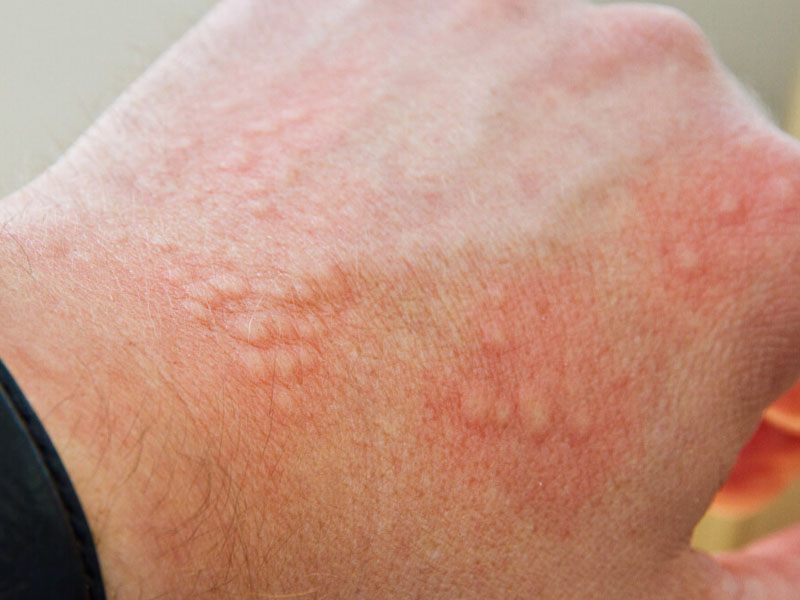 Bệnh viêm da tiếp xúc