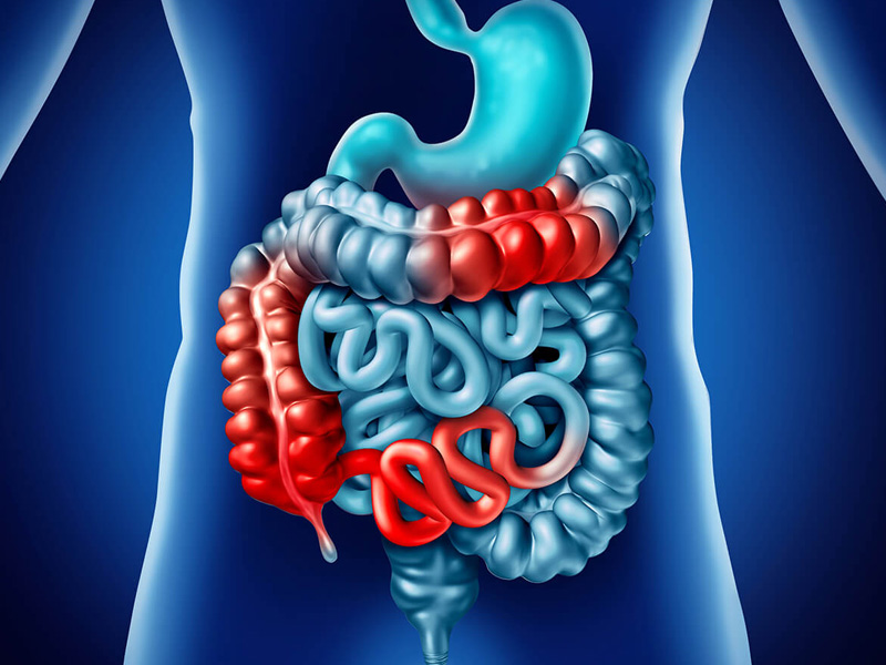 viêm đại tràng và cách điều trị