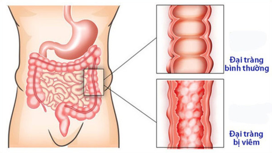 đau quặn bụng dưới