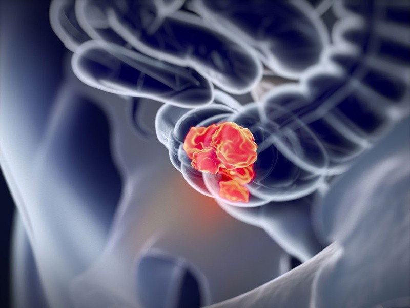 Viêm đại tràng có nguy hiểm không