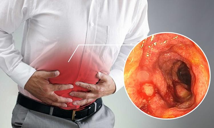 viêm đại tràng mãn tính có chữa được không