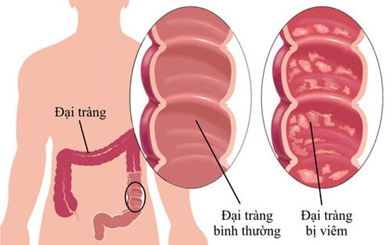 hình ảnh viêm đại tràng mãn tính