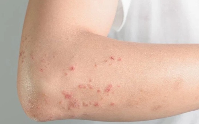 dấu hiệu bệnh viêm gan b