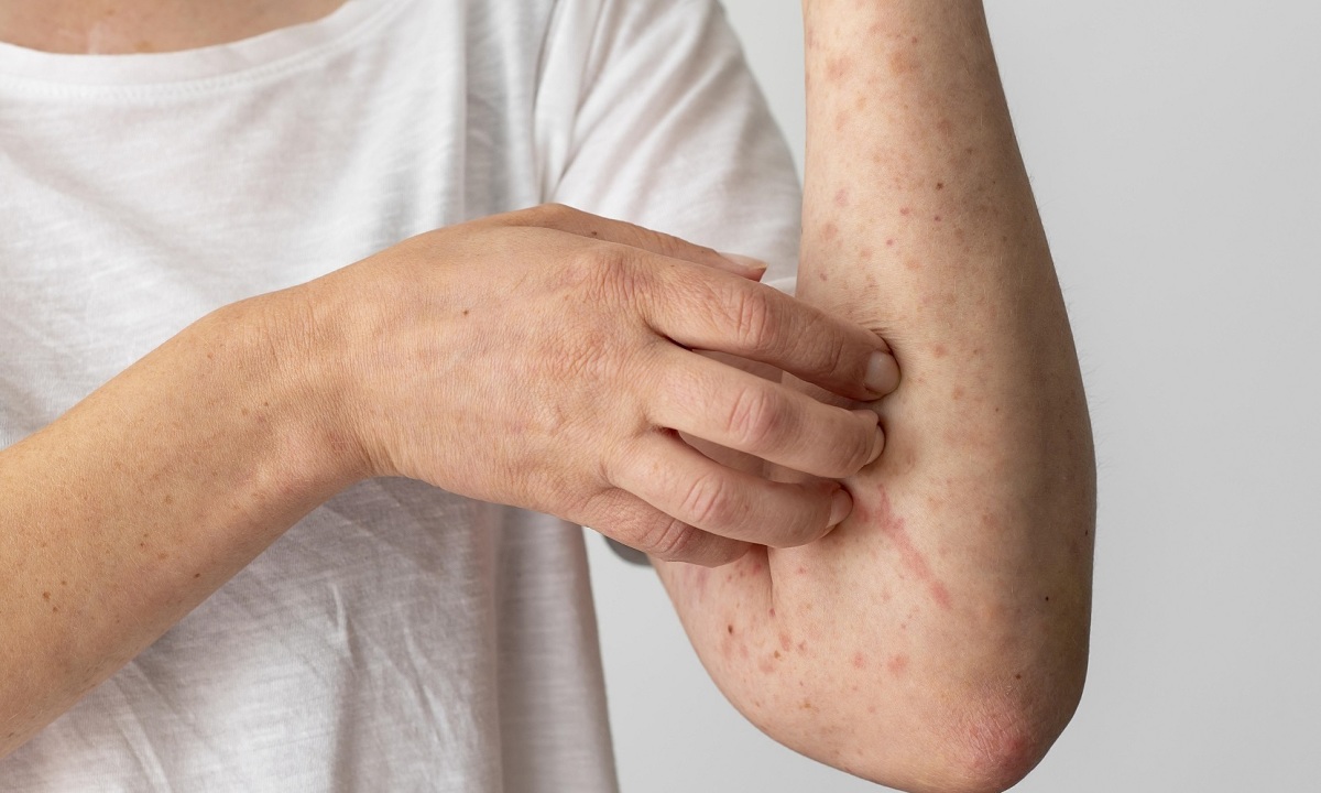 Viêm gan B gây ngứa ngáy, nổi mẩn da