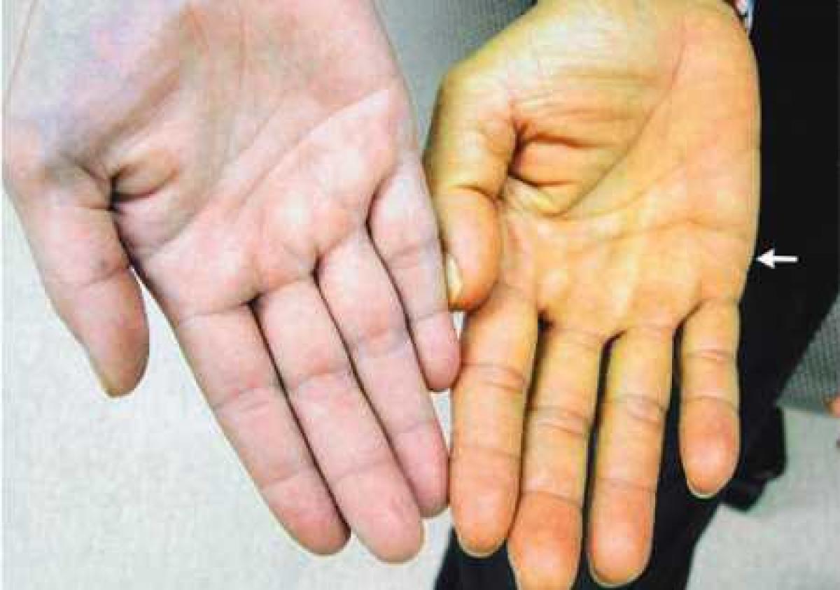 viêm gan mạn tính