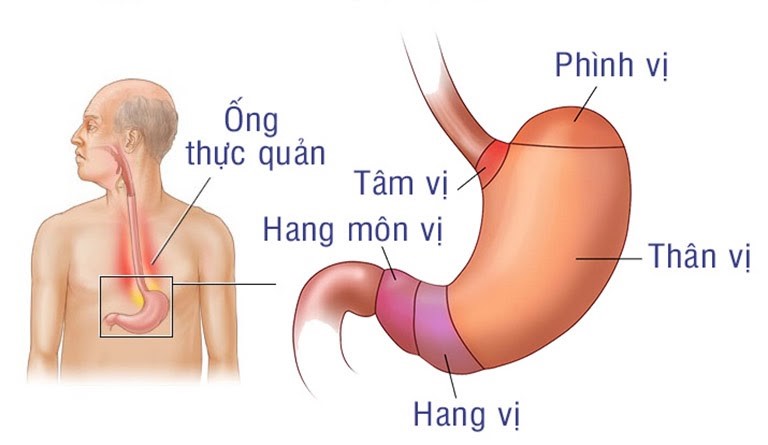 viêm hang vị dạ dày