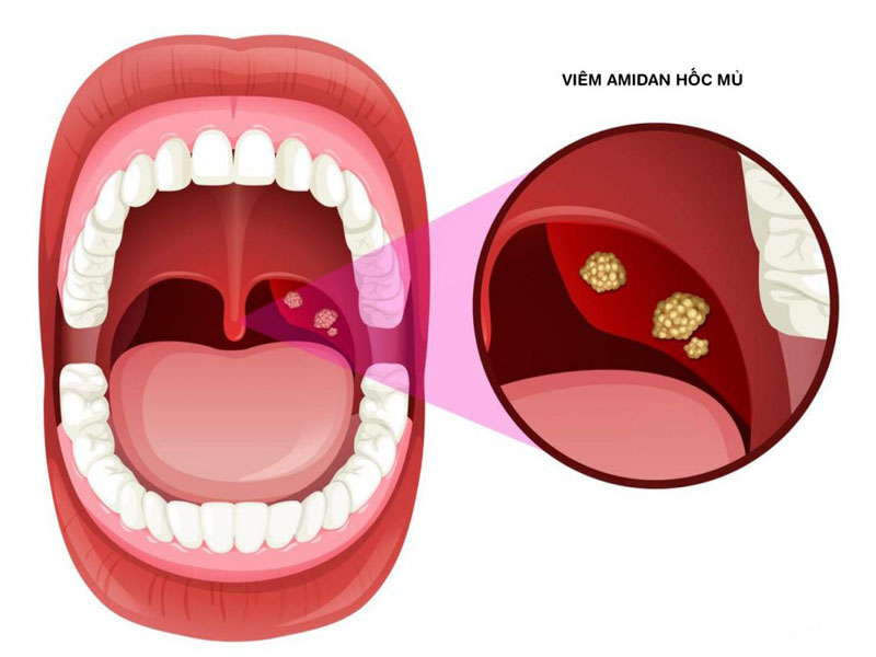 Viêm họng amidan cấp mủ là bệnh nguy hiểm và cần điều trị sớm