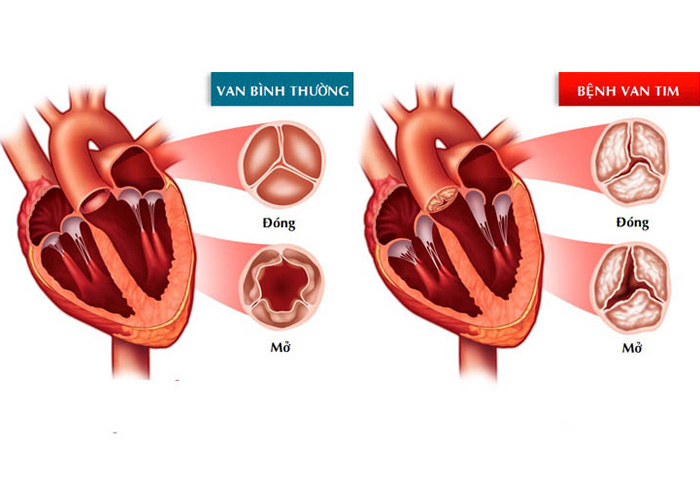 viêm họng cấp tính